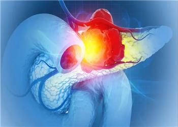 امید تازه برای درمان مقاومترین سرطان؛ دانشمندان تومورهای پانکراس را در موشها نابود کردند